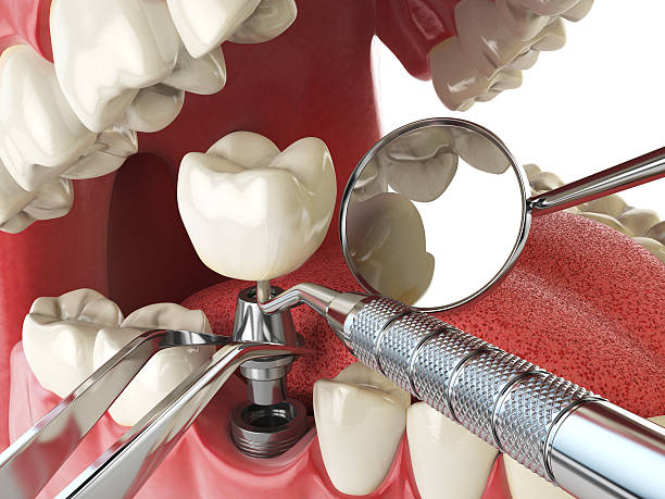 Best Broken or Chipped Tooth Repair in Dutch Island, GA